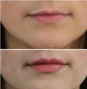 Médico Estético en Piedras Negras. Resultados efectivos 2 labios