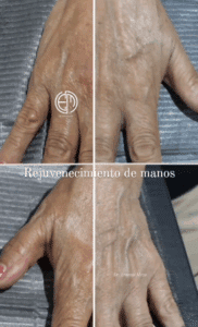 Médico Estético en Piedras Negras. Resultados efectivos 6 manos