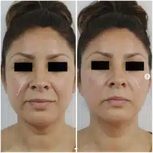 Médico Estético en Piedras Negras. Resultados efectivos 4 rostro